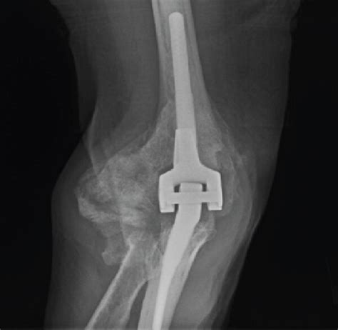 A B Marked Heterotopic Ossification Ho Seen Around The Prosthesis Download Scientific