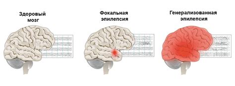 Эпилепсия - симптомы, причины, диагностика и лечение в лучших клиниках ...