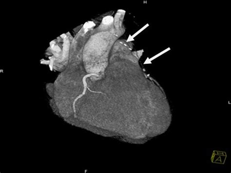 9 Computerized tomographic coronary arteriography (2012): LIMA graft ...