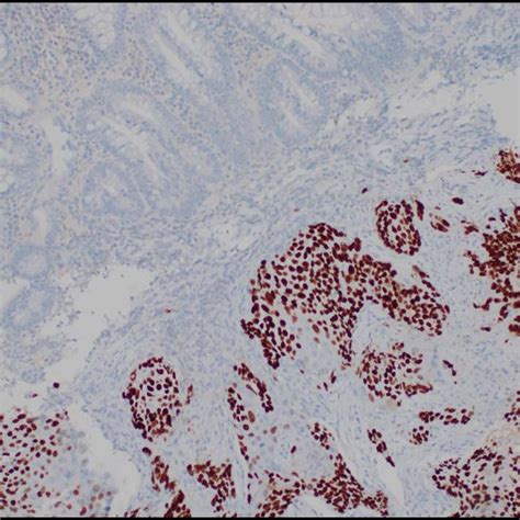 The Tumor Cells In The Colonic Biopsy Are Diffusely Positive For P