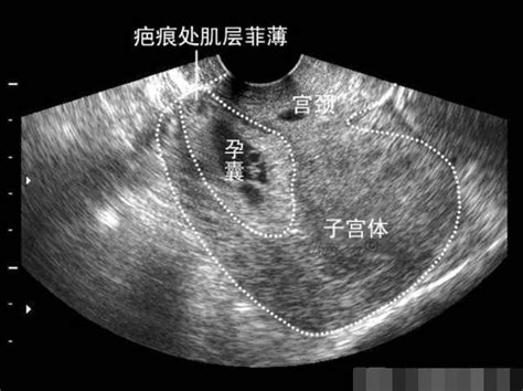 97年孕妇怀胎8月被逼引产 当医生告知原因 孕妇瞬间如五雷轰顶