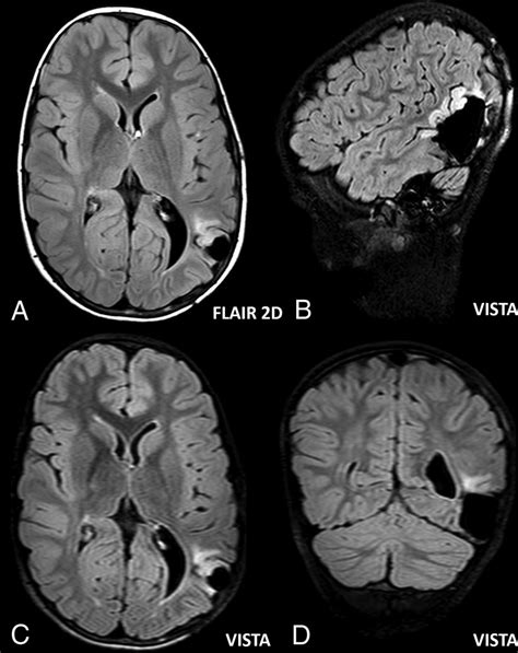 Effectiveness Of 3d T2 Weighted Flair Fse Sequences With Fat