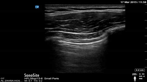 Sliding Sign Ultrasound