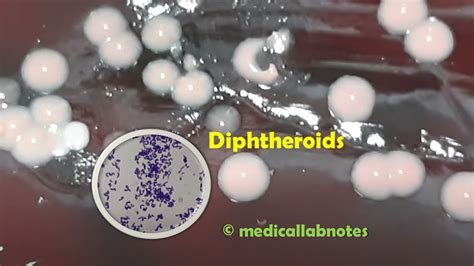 Introduction of Diphtheria bacillus and Diphtheroids Archives - Medical Notes