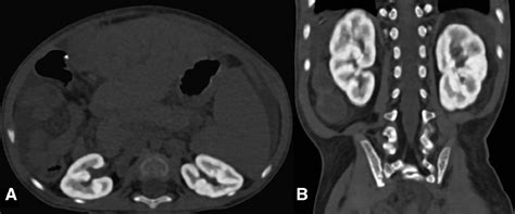 Primary Hyperoxaluria Imaging Of Renal Oxalosis Urology