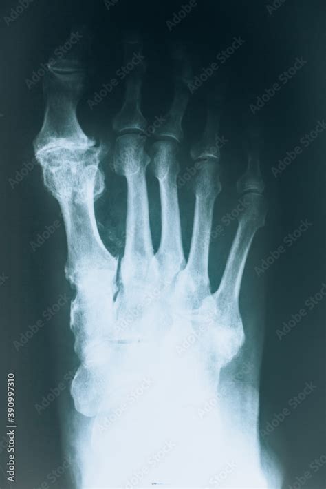 X-ray of the bones of the foot. Foot injuries Stock Photo | Adobe Stock