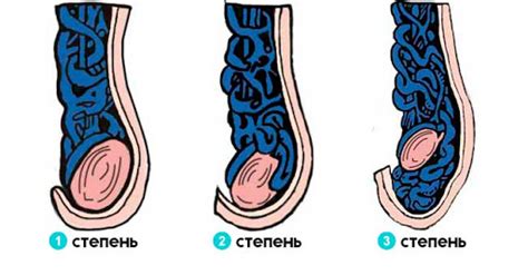 Варикоцеле: Симптомы Причины Лечение ⋮ Medical Plaza