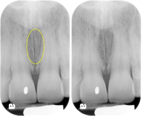 Maxillary Landmarks Pictures Flashcards Quizlet