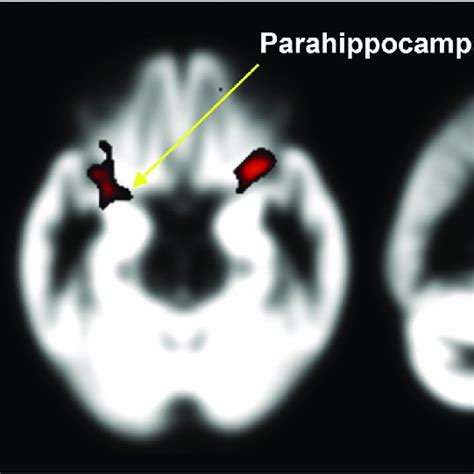 Decreased Gray Matter Volumes Of Insula Amygdala Parahippocampal