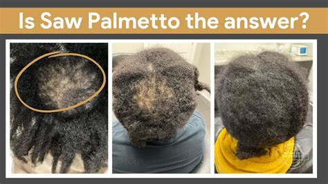 Saw Palmetto A Game Changer For Hair Loss Sawpalmetto Hairgrowth