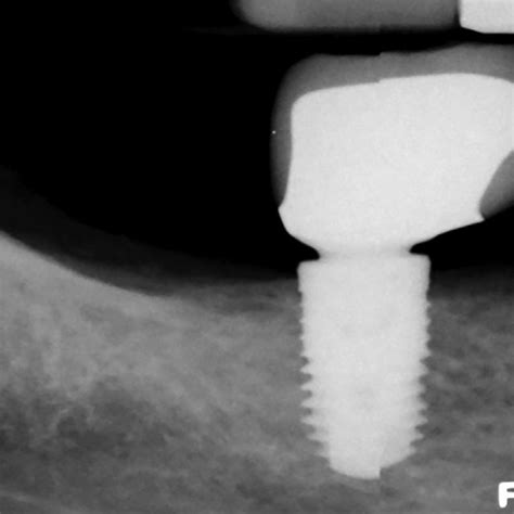 A Implant Crown Screw Access Hole B Screw Cementable Implant Crown