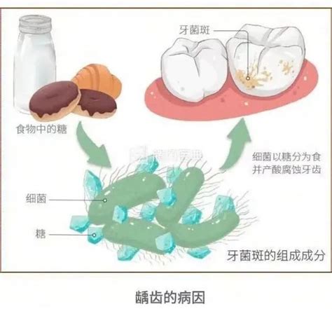 国家医疗保障局 医保动态 如何通过涂氟预防宝宝蛀牙