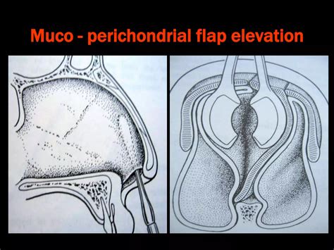 Deviated nasal septum and other septal conditions | PPT