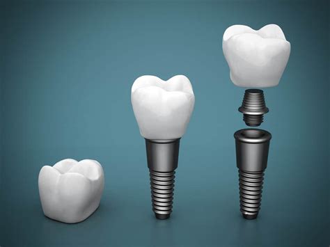 Cuáles son las partes de un implante dental implante y corona