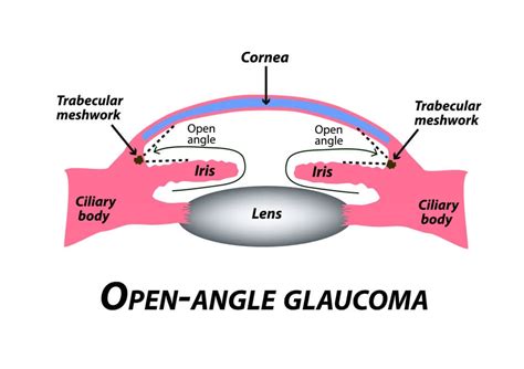 What Are the Types of Glaucoma? | Michigan Glaucoma & Cataract