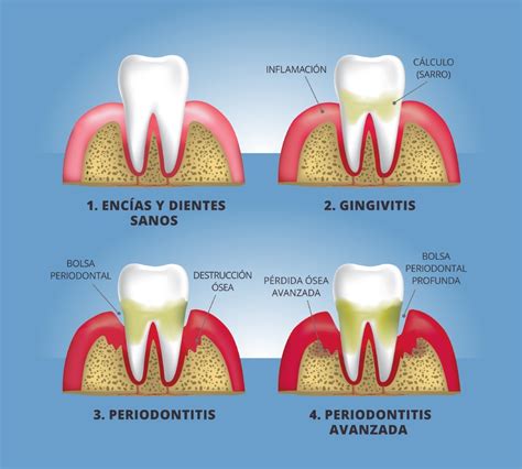 Descubre Todo Sobre La Bolsa Periodontal Y Su Importancia Cl Nica