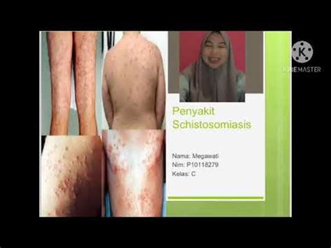 Materi Penyakit Schistosomiasis Youtube