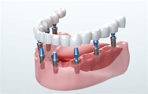 Dental Implants A 5 Step Plan To Restoring Your Teeth Aging