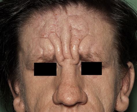 Isolated Cutis Verticis Gyrata Of The Glabella And Nasal Bridge A Case