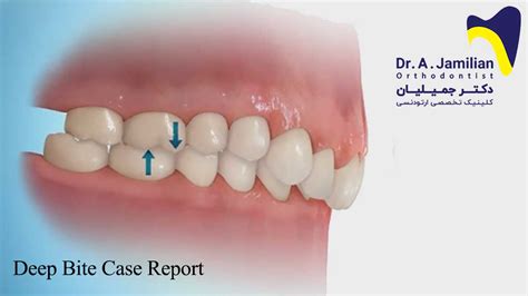 Case Report Deep Bite Dr Jamilian