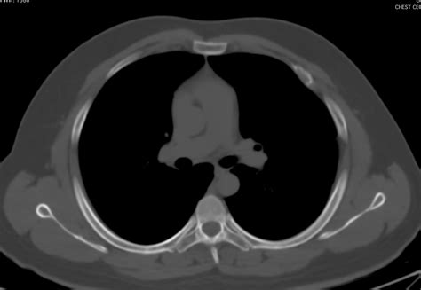 Supernumerary Intrathoracic Rib Image