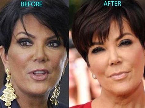 Kris Jenner before and after using botox – Celebrity plastic surgery online