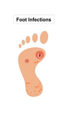 Diabetes and Feet – Diabetic Foot Infection - Apollo Sugar Clinics