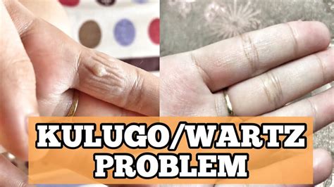 Murang Pantanggal Ng Kulugo Warts In Days Very Effective Youtube