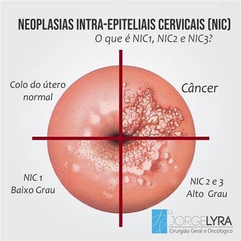 Neoplasias Intra Epiteliais Cervicais Nic S O As Les Es Precursoras