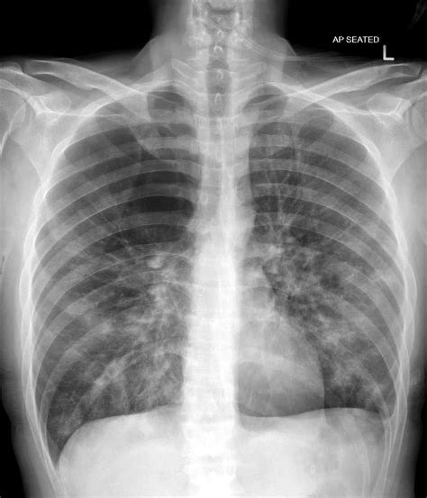 Barrel Chest Copd Emphysema