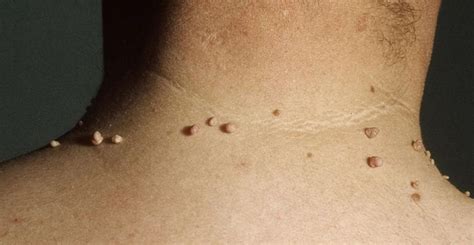 Neck Skin Tags Affect Millions Of People Here’s How To Remove Them Safely Molluscum Pendulum