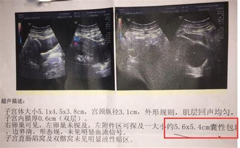 月經不調是卵巢囊腫嗎？能懷孕嗎？卵巢囊腫的原因、症狀和治療 每日頭條