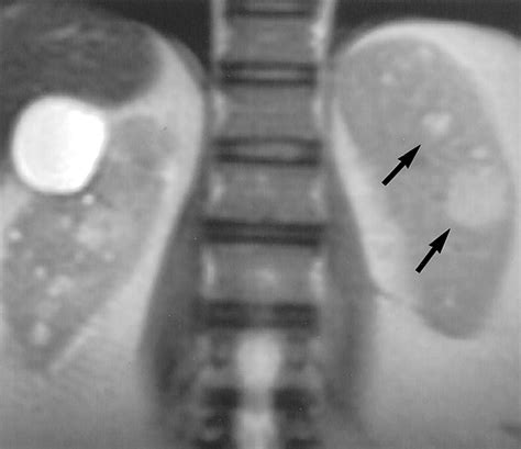 Mr Imaging Of The Spleen Spectrum Of Abnormalities Radiographics