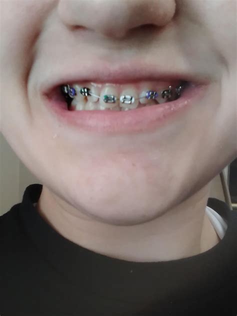 Power chain broke : r/braces