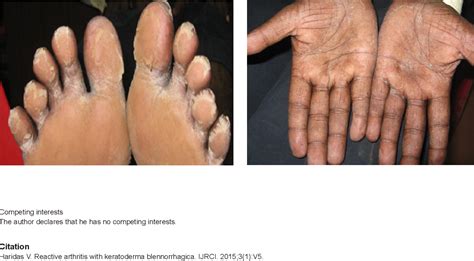 Keratoderma Blennorrhagicum