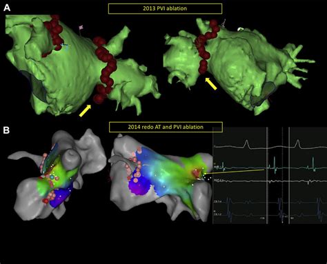 Electroantomic Mapping Radiofrequency Ablation In And A