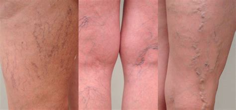 Varicose And Spider Veins Exclusive Vein Care