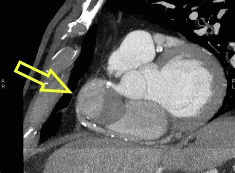 From Coronary Artery Ectasia To Giant Coronary Artery Aneurysm Is It