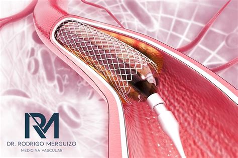 O que é a angioplastia de membros inferiores Dr Rodrigo Merguizo