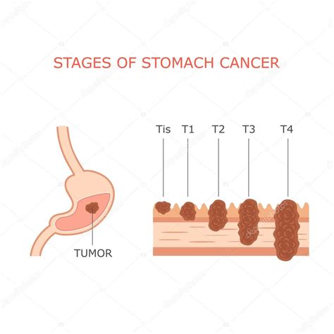 Stomach cancer stages — Stock Vector © eveleen #76176243