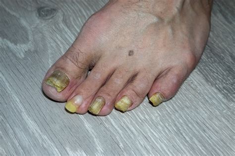 Unhas Amareladas - Unhas amareladas: 7 causas e quando se preocupar - Minha Vida