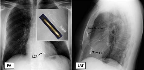 The Leadless Cardiac Pacemaker Conductive Communication JACC