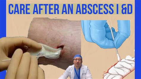 How To Pack An Abscess I D Site Wound Packing After Incision And