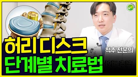 허리디스크 초기 이렇게하고나서 일주일만에 나았습니다 수술없이 초기에 잡는법 Youtube