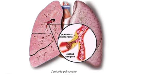 L embolie pulmonaire Physiopathologie symptômes Pronostic et