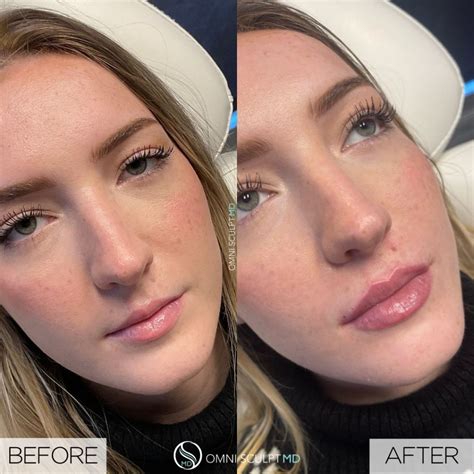 Lip Injection Before After Gallery OMNI SCULPT MD