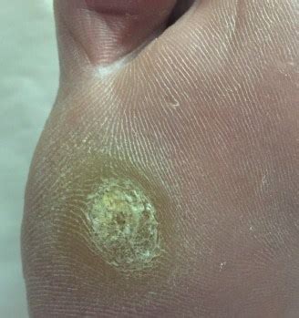 #9 What Causes Warts? 10 Most Common Questions Asked of a Foot Doctor ...