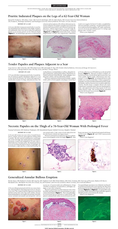 Generalized Annular Bullous Eruption—quiz Case Dermatology Jama Dermatology Jama Network