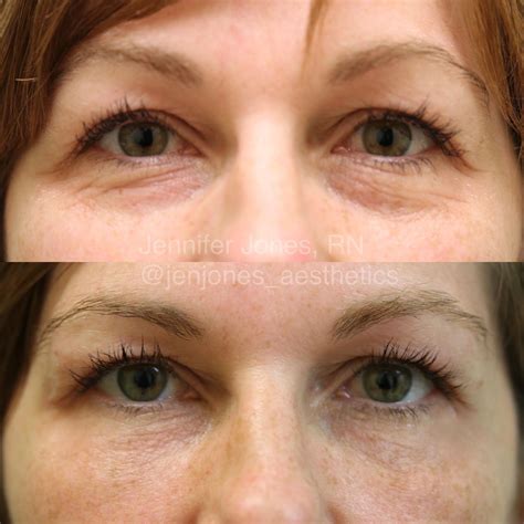 Tear Trough Filler Helps To Restore The Volume Loss Under The Eyes