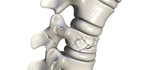 Synovial Cyst Symptoms Causes And Treatment Options